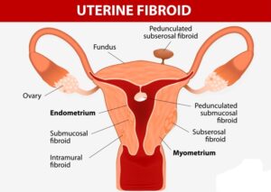 WHAT ARE UTERINE FIBROIDS