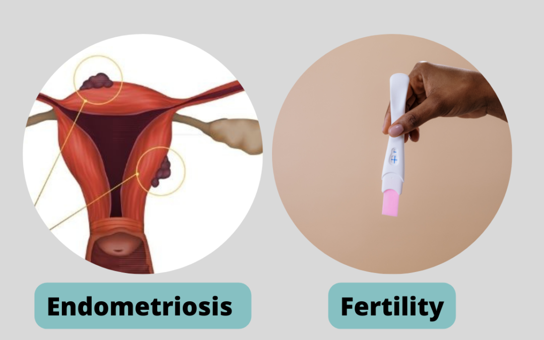 ENDOMETRIOSIS AND INFERTIITY